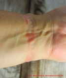 Honor Band 5 Allergie